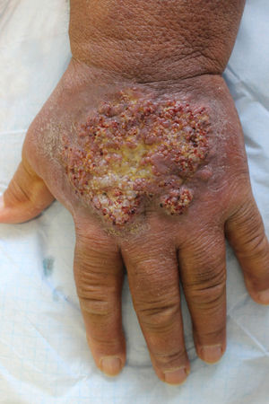 Clinical image. A purplish-brown verrucous plaque with central ulceration, occupying almost the entire back of the left hand. Oedema and hyperpigmentation of the left upper arm.