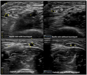 Transverse image of the basilic and cephalic veins. Measurements of vein diameter, distance to surface and distance to artery were performed. Evaluation with and without tourniquet is shown.