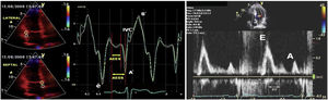 Positive or negative waves in pulsed wave doppler and tissue doppler imaging. Abbreviations: A; mitral late diastolic peak velocity, A′; late diastolic myocardial peak velocity, DT; deceleration time, E; early mitral diastolic peak velocity, é; early diastolic myocardial peak velocity, IVC; isovolumetric contraction, IVRT; isovolumetric relaxation time, S′; systolic myocardial peak velocity.