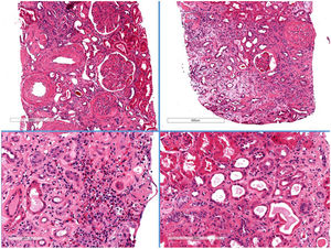 Renal biopsy histology. Haematoxylin-eosin. Global sclerosis is evident in 21/40 glomeruli. Diffuse mesangial enlargement with images of nodular transformation. Severe foci of patchy oedema with mononuclear inflammatory infiltrate with abundant eosinophils. Fibrosis and moderate tubular atrophy with flattening of the epithelium, without tubulitis. The arteries show moderate-to-intense arteriosclerosis, and the arterioles show intense hyaline lesions.