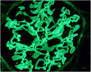 Intense linear staining in capillary basement membranes with anti-IgG antiserum. ×63.