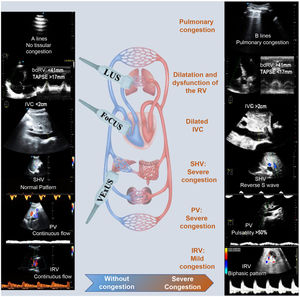 On the left normal ultrasound pattern using LUS, FoCUS and VExUS. On the right severe congestion pattern. bdRV: right ventricle basal diameter; TAPSE: Tricuspid Annular Plane Systolic Excursion; IVC: inferior vena cava; RV: right ventricle; PV: portal vein; IRV: intrarenal vessels, SHV: suprahepatic veins.
