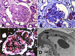 (A) Glomerulus with solidified appearance, with loss of or reduction in capillary lumen, some capillary walls are thickened and there are hyaline segments (arrows) that may correspond to segments with irreversible damage and protein exudates or to intracapillary thrombi (haematoxylin-eosin, X400). (B) Glomerulus with ischaemic retraction, compaction and hyaline segments (short arrows), and a recent intracapillary thrombus (long arrow) (Masson trichrome, X400). (C) Intracapillary accumulations of hyaline or proteinaceous material (short arrows) that may correspond to segments of hyalinosis or to organising thrombi; a double contour is observed (long arrow) and the capillary lumen are narrow (methenamine silver, X400). (D) Diffuse podocyte injury with loss of pedicles, marked subendothelial oedema with loss of fenestrations (arrow); in other capillaries, double contours are detected, without electron-dense deposits (transmission electron microscopy, original magnification, X2.100).