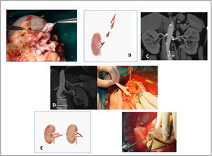 A: Shotgun barrel anastomosis and terminolateral anastomosis in a kidney from a living donor. B: Use of the hypogastric artery to obtain a single artery. C: Atheroma plaques in the ostium. D: Fibromuscular dysplasia of the unilateral intima. Bench surgery repair with a cadaveric graft. E: Repair of arterial aneurism by means of cadaveric arterial graft in bench surgery. F: Exeresis of a tumour in bench surgery.