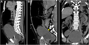 A) Sagittal multiplanar reconstruction (MPR) revealing the dimensions of the bladder. We can observe the loops of the large intestine dilated above the bladder. There was no associated dilation of the small intestine. We observed an anterior interposition of the colonic loops to the liver (Chilaiditi syndrome). B) Sagittal MPR revealing an abrupt change in the calibre of the sigmoid colon (yellow arrowhead). C) Axial MPR identifying pyeloureteral dilation compatible with grade III hydronephrosis.