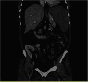 Abdominal computerised tomography scan that shows large splenomegaly, oedema of the intestinal wall, and ascites.