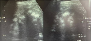Ultrasound performed on the mother of the patients. Kidneys with heterogeneous echogenicity due to increased echogenicity of the renal pyramids consistent with grade II-III bilateral medullary nephrocalcinosis. Corticomedullary differentiation is poor, with signs of diffuse chronic nephropathy.