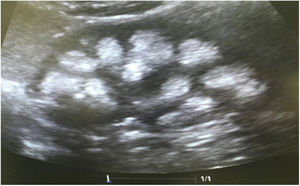 Renal ultrasound of case 1, with pyramid-shaped hyperechogenic images diffusely distributed in the medullary region without projecting a posterior acoustic shadow. Consistent with severe bilateral nephrocalcinosis.
