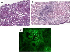 Renal biopsy images: (A) Image showing glomeruli with mostly normal characteristics; (B) image showing acute interstitial infiltrate with a predominance of lymphocytes and eosinophils together with some ruptured tubules; (C) Image showing positivity of anti-IgA immunofixation.