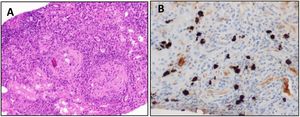 Renal biopsy specimen. (A) Light microscopy shows a severe interstitial lymphoplasmacytic infiltrate (H&E, 20×). (B) The immunohistochemical study revels>30 IgG4 positive plasmocytes per large magnification field (IgG 4 immunohistochemistry, 40×).