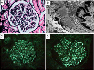 A. Methenamine silver stain. Thickening of capillary walls without proliferative lesions. B. Electron microscopy. Subepithelial electron-dense deposits and pedicellar fusion. C and D. Immunofluorescence on pronase-treated paraffin-embedded tissue: parietal granular deposition of IgG (+++)3 and kappa (+++).4