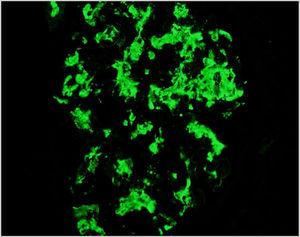 Immunofluorescence: IgA deposition.