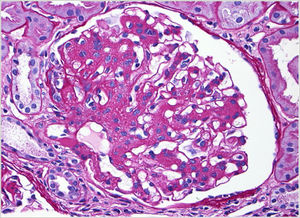 Light microscopy: mesangial proliferation.