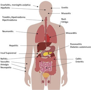 Adverse immune effects produced by check-point inhibitors (CPI).