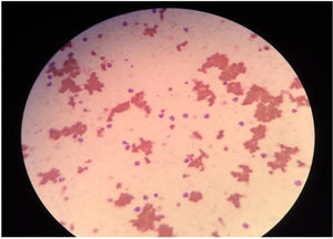 The blood smear shows agglutinated clusters of erythrocytes.