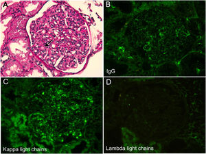 Kidney biopsy. (A) Light microscopy (periodic acid–Schiff stain, 400×), with glomerulus showing endocapillary proliferation and double-contour formation along the capillary walls (arrow). (B) Immunofluorescence with deposits of immunoglobulin (IgG). (C) Immunofluorescence with deposits of kappa light chains. (D) Immunofluorescence with no deposits of lambda light chains.