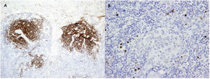 (A) Expanded concentric meshworks of follicular dendritic cells. CD21 immunostaining, 10×. (B) Immunostaining for herpesvirus 8, 40×.