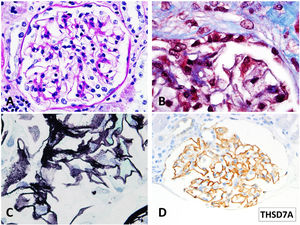 Light microscopy findings. (A) PAS. 40×. Minimal segmental increase in mesangial matrix. Peripheral glomerular capillaries appear stiff and slightly thickened (B) Masson trichrome stain. 100×. Detail of fuchsinophylic deposits in peripheral glomerular capillaries. (C) Silver–Methenamine stain. 100×. Detail of the vacuolated appearance of the glomerular basement membrane. Some small projections (spikes) of silver-positive material in the subepithelial aspect of the glomerular basement membrane are seen. (D) TSHD7A Paraffin immunohistochemistry. 40×. Positive granular stain in peripheral glomerular capillary walls.