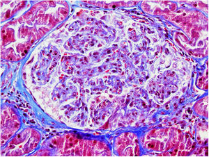 Masson's trichrome. Glomerulus with global endocapillary hypercellularity, leucocytoclasia and red cell fragmentation in the capillary tuft close to the vascular pole.