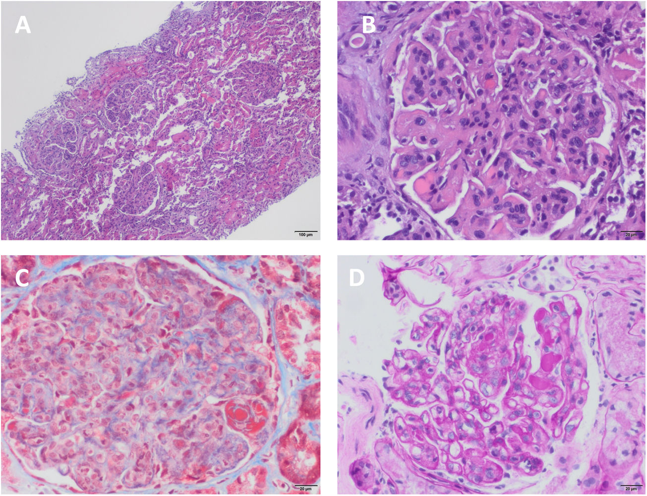 Inmunoglobulinmediated glomerulonephritis and mixed cryoglobulinemia