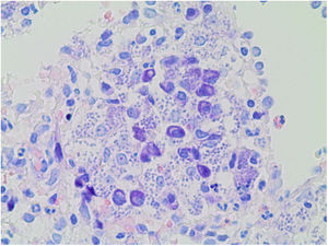 Splenic biopsy, Giemsa staining. Microorganisms corresponding to Leishmania with rounded or oval morphology inside the cytoplasm of macrophages/histiocytes.