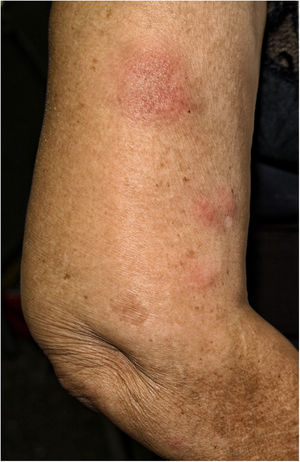 Erythematous and painful nodules on pressure located on the arms.