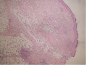 Hematoxylin-eosin (4×): skin with epidermis without significant histological alterations. Papillary and reticular dermis with moderate perivascular inflammatory infiltrate. Inflammation extends to subcutaneous cellular tissue.