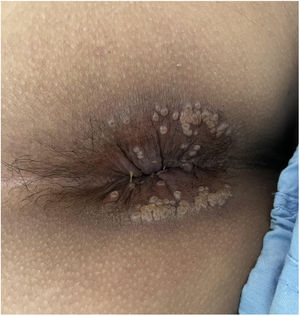 Initial stage of the lesions.