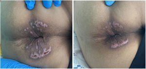 Lesions before and after treatment.