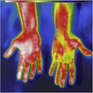 Thermal image after the creation of an AVF, comparing the hand on the intervened arm (on the left of the image) with the hand on the non-intervened arm (on the right of the image).