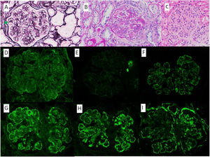 A) Methenamine silver, ×40: glomerulus with increased mesangial matrix and focal double contours (arrow). B) PAS, ×40: glomerulus with presence of double contours and occlusion of capillary lumens. C) HE, ×40: glomerulus with accentuation of the lobular pattern and increased endocapillary cellularity. Mesangial and capillary loops granular deposits of IgG +++ (D), IgA ++ (E), IgM ++ (F), Kappa ++ (G), Lambda ++ (H) and C3 +++ (I).