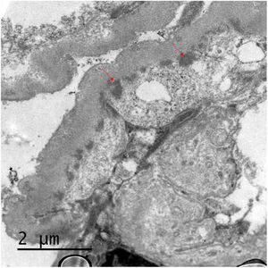 Electron microscopy: unstructured electrodense deposits are observed at the subepithelial side of the basement membranes (red arrows), with reduplication of the basement membranes. Podocytes show extensive pedicellar fusion.