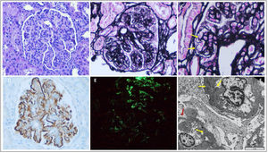 Renal biopsy: Glomerulus with mesangial and endocapillar proliferation and diffuse thickening of capillary loops (A and B), and the presence of double contours (C, black arrows). Immunohistochemical staining for C4d positive granular pattern in mesangial and subendothelium (D) and positivity for IgM in the pattern (E). Electron microscopy (F) shows mesangial and subendothelial electrodense deposits (black arrows) and unfolding of the glomerular basement membrane (G). A) Hematoxylin-eosin 20×, B) methenamine silver 20×, C) methenamine silver 60×, D) immunoperoxidase 20×, E) direct immunofluorescence 20× and F) electron microscopy 2000×.