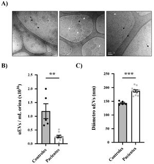 Morphological characterization of uEVs in patients and controls. (A) Details of representative samples with different scales (500 nm, 200 nm and 100 nm from left to right) showing single (white arrow), double (continuous black arrow) or multilayered (dashed black arrow) vesicles. (B) Quantification of uEV concentration per mL of urine in controls (black circles) or patients (gray circles). Each point represents one subject. The mean ± SEM is also shown in the graph. (C) Quantification of uEV diameter of controls (black circles) and patients (gray circles). Each point represents the mean uEV diameter for a single subject. The graph also shows the mean ± SEM. CD81: differentiation group 81; GRP78: glucose regulatory protein 78; HepG2: hepatocellular carcinoma cell line G2; uEV: urinary exosome-like vesicles; SN: supernatant. ** p < 0.01. ***p < 0.001.