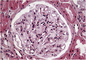 Optical microscopy. Focal and segmental increase in the mesangial matrix, endothelial and epithelial cells with broad and multivacuolar cytoplasm, tubular foam cells.