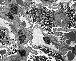 Electronic microscopy. Massive number of myelin-like inclusions predominantly located within podocytes, with a minimal proportion in endothelial, mesangial and tubular cells.