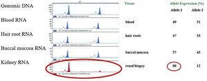 Determination of the inactivation status of the X chromosome (XCI) in different tissues of the patient. The first panel shows the amplification of the AR gene in the genomic DNA carried out to correct the preferential amplification of the smallest allele (allele 1). The rest of the panels show the expression of both AR gene alleles in blood, capillary roots, buccal mucosa and kidney. The table on the right shows the quantification of the relative expression levels of both AR alleles, showing random inactivation of the X chromosome in all samples analysed except kidney (>% of the mutated allele).