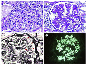 (A) H&E: 20×. Glomerulus with lobulated morphology, mesangial expansion due to matrix and mesangial and endocapillary proliferation. (B) PAS 20×: PAS positive mesangial expansion, with increased cellularity. (C) Methenamine silver 64×. Images of double contours in the glomerular capillary loops (red arrows). (D) Direct immunofluorescence (DIF) IgG 20×. Intense deposit (3+) in a coarse granular pattern and with a subendothelial and mesangial location for IgG.