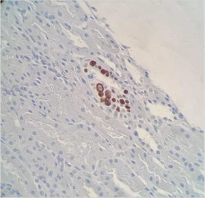 Positive immunohistochemistry for SV40 antigen in JC virus-infected tubular cells.