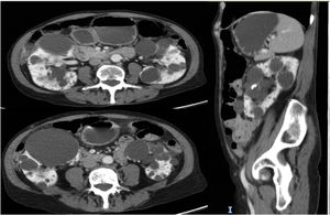 Compression of intestinal loops by large renal cysts compatible with megacolon.