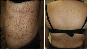 Erythematous papules with mild hyperkeratosis on the trunk.