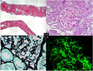 Renal biopsy. Optical microscopy. (A) Renal cortical parenchyma with preserved general architecture and without significant chronic changes (Masson’s trichrome). (B) Glomeruli with no mesangial expansion, proliferative lesions or other morphological alterations (PAS, 20×). (C) Glomerulus with very focal spikes of basement membrane (silver, 40×). (D) DIF: IgG and granular mesangial C3 deposits in capillary loops and IgM and mesangial C1q deposits (IgG, 40×).