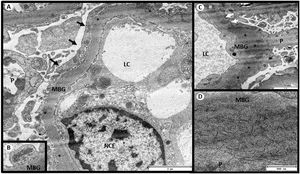 Electron microscopy. (A) Glomerulus with massive pedicel fusion (black arrows). (B) Presence of tubuloreticular inclusions in the endothelium. (C) Moderately electrodense deposits in the subepithelium (*) with spiculated reaction of the lamina densa (white arrows). (D) Deposits organized in the form of fibrils. Transmission electron microscopy A and C: 5,000×, B: 8,000×, D: 1,2000×. CL: capillary lumen; GBM: glomerular basement membrane; ECN: endothelial cell nucleus; P: podocyte.