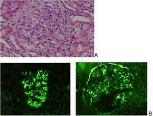 (A) Optical microscopic image showing glomerulus with mesangial proliferation at the expense of cellularity and matrix. (B) Immunofluorescence image with abundant and intense mesangial deposition for IgA (left) and C3 (right), this antibody also localized in Bowman