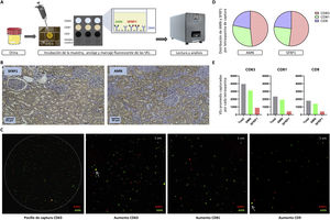 (A) ExoView® workflow. Urine, without previous isolation of EVs, is added on the central part of the chip, which contains the wells where the EVs are captured by the different tetraspanins (CD63, CD81 and CD9). These EVs are fluorescently labeled in green if they express AMN or in red if they express SFRP1. The chips are read and analysed in the ExoView® R200. (B) Analysis of AMN and SFRP1 in human renal tissue by immunohistochemistry. Both glomeruli and tubules are visible (×10 magnification), with only the latter being stained, as they are the functional structures related to our proteins of interest. (C) Visualization of the capture of the proteins of interest (AMN, SFRP1). An image of one of the wells of the CD63 capture tetraspanin is shown, in which the specific and delimited binding of EVs can be appreciated. On the right, a magnification of a well for each capture tetraspanin (CD63, CD81 and CD9, respectively) is included, with each coloured dot being a vesicle expressing AMN (membrane protein, in green) or SFRP1 (intracellular protein, in red). In addition, the co-localization of both proteins (yellow) in the same EV is indicated by arrows. (D) Distribution (%) of AMN and SFRP1 proteins by capture tetraspanin (CD63 in red, CD81 in green and CD9 in blue). (E) Quantification of captured EVs containing either of the two studied proteins (AMN in green and SFRP1 in red), for each of the tetraspanins (CD63, CD81 and CD9). Average values are shown for the 3 wells for each capture tetraspanin.