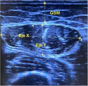 Measurements of the anterior rectus of quadriceps (X and Y axes) and supramuscular fat. GSM: Supramuscular fat.