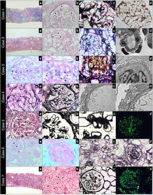 Case 1. Panoramic view of a cortical fragment —Masson’s trichrome— (a). Glomerulus showing rigid capillary loops (arrows) —periodic acid-Schiff— (b). Capillary loops with microspicules (arrows) in the external sector of the glomerular basement membrane —methenamine silver— (c). Immunohistochemistry with intense positivity for antibodies against phospholipase A2 in the glomerular basement membrane (d). Case 2. Panoramic view of a cortical fragment —Masson’s trichrome— (a). Glomerulus showing rigid capillary loops (arrows) —periodic acid-Schiff— (b). Thin basement membranes (arrows) without spicules or double contours —methenamine silver- (c). Electron microscopy showing a glomerular capillary loop without deposits and diffuse pedicellar fusion (arrows) (d). Case 3. Glomerulus with segmental intracapillary hypercellularity (arrows) —periodic acid-Schiff— (a). Capillary loops at higher magnification, with occasional double contour images (arrows) —periodic acid-Schiff— (b). Glomerulus with segmental double contour images in the glomerular basement membrane (arrows) —methenamine silver— (c). Electron microscopy showing diffuse subendothelial deposits (*) and pedicellar fusion (arrows) (d). Case 4. Glomerulus showing rigid capillary loops (arrows) —periodic acid-Schiff— (a). Rigid glomerular capillary loops (arrows) —methenamine silver— (b). Electron microscopy showing regular and diffuse subepithelial deposits (*) in the external sector of the glomerular basement membrane, and diffuse pedicellar fusion (arrows) (c and d). Case 5. Glomerulus showing thickened and rigid capillary loops (arrows) —periodic acid-Schiff staining— (a). Diffuse spicules on the outer slope of the glomerular basement membrane (arrows) —methenamine silver staining— (b and c). Direct immunofluorescence with IgG staining showing a fine granular pericapillary pattern (d). Case 6. Glomerulus with infolding of the basement membranes (arrows); interlobular artery with myointimal fibrosis (*) and arteriole with luminal thrombosis (‡) —periodic acid-Schiff staining— (a). Arteriole at higher magnification, with complete occlusion of the lumen (*) and collagenization of the arteriolar wall (‡) —periodic acid-Schiff staining— (b). Vessels of different calibers with complete occlusion of the vascular lumen (*) —methenamine silver staining— (c and d). Case 7. Panoramic view of a cortical fragment —periodic acid-Schiff— (a). Glomerulus showing regular thickening (arrows) of the glomerular basement membrane of the capillary loops —periodic acid-Schiff— (b). Glomerulus with rigid capillary loops (arrows) —methenamine silver— (c). Direct immunofluorescence staining for IgG with a fine granular pericapillary pattern (d).
