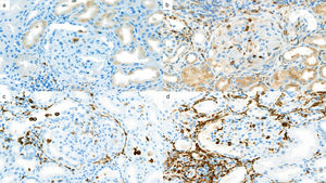 CD68 (a and b), and CD163 (c and d) expression. Glomerular and interstitial regions are differentially involved, with images on the left showing less severe staining (IHC, original magnification ×40).