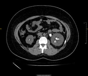 Non-contrast CT KUB which shows a swollen left kidney secondary to a stone with maximal size of 2.0cm in the left PUJ as well as multiple small stones in the right lower calyces of the kidney and left middle and lower calyces. This highlights the patient's significant stone burden despite being on optimal treatment for cystinuria.