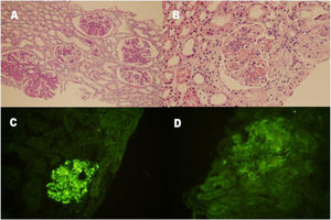 Renal histopathological findings. (A and B) Mesangial hypercellularity and thickening of the glomerular capillary wall with double contour formation, giving the glomeruli a lobular appearance (periodic acid staining, 100× and hematoxylin–eosin staining, 200×). (C) Granular C3 deposition (+++) along the capillary wall and in the mesangium (indirect immunofluorescence staining on frozen tissue, 200×). (D) Segmental IgG deposition (+) along the capillary wall and in the mesangium (indirect immunofluorescence staining on frozen tissue, 200×).
